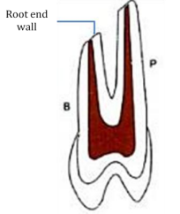 2100_Define mineral trioxide aggregate - root end filling.png