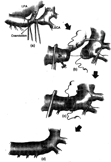 2337_Coarctation of aartn-resection and end-to-end anestomosis.png